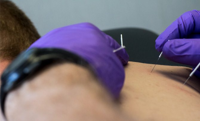 Dry Needling - Performance Therapies