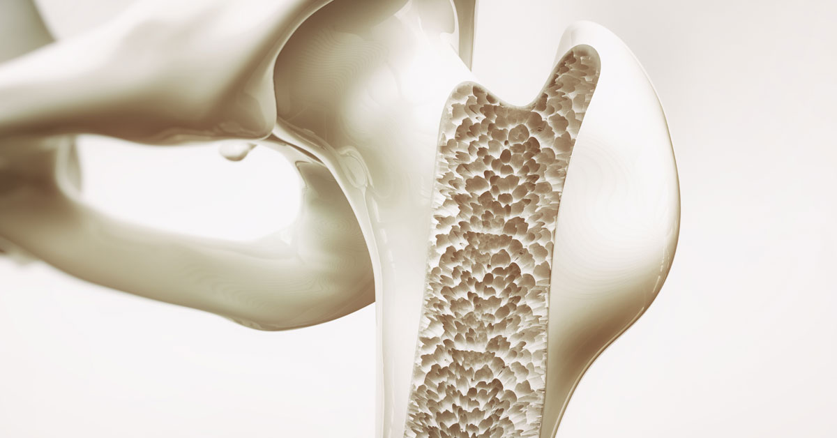 How Physical Therapy Can Help Fight Osteoporosis – Performance Therapies